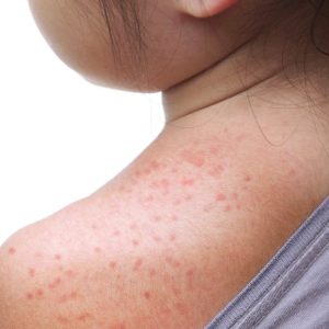 measles