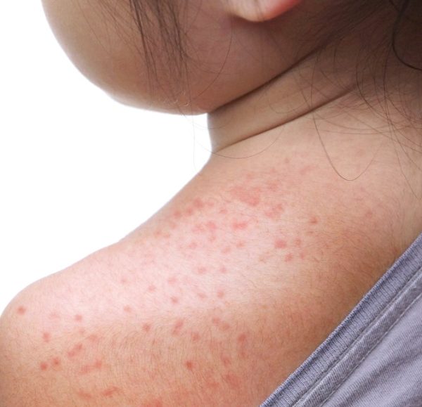 With measles cases on the rise, health officials urge vaccination and vigilance