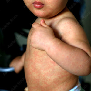 Child with measles symptoms