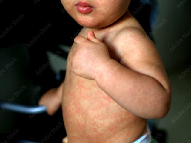 Measles cases have reached a 35-year high