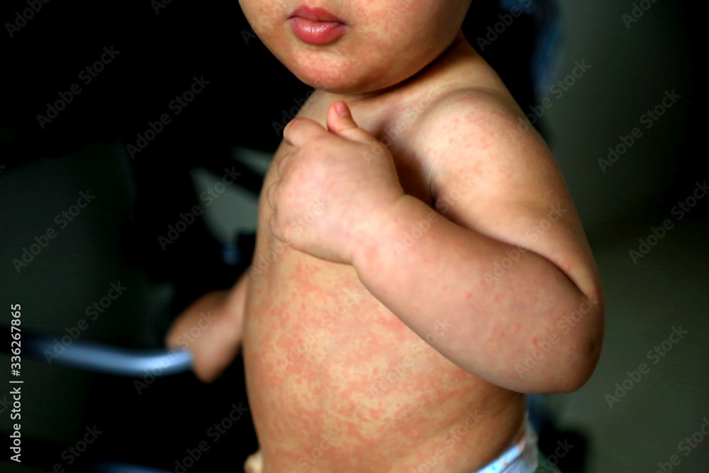 Measles cases have reached a 35-year high